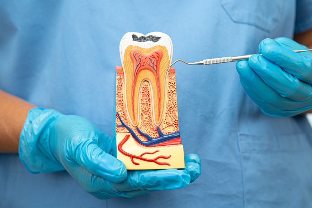 Dentist holding a detailed tooth model and pointing to infected pulp area to explain root canal treatment in La Mesa – Root Canals La Mesa