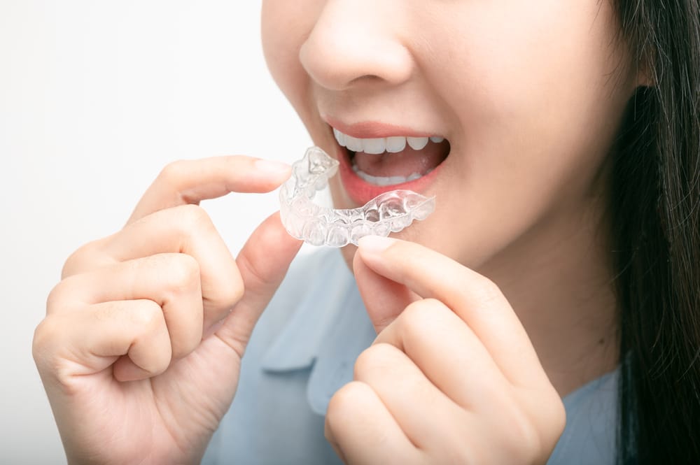 Woman inserting clear aligners onto her teeth, demonstrating convenient and discreet orthodontic treatment in San Diego – Clear Aligners San Diego